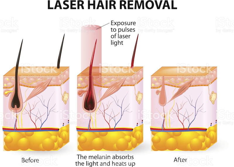 Laser-Haarentfernung
